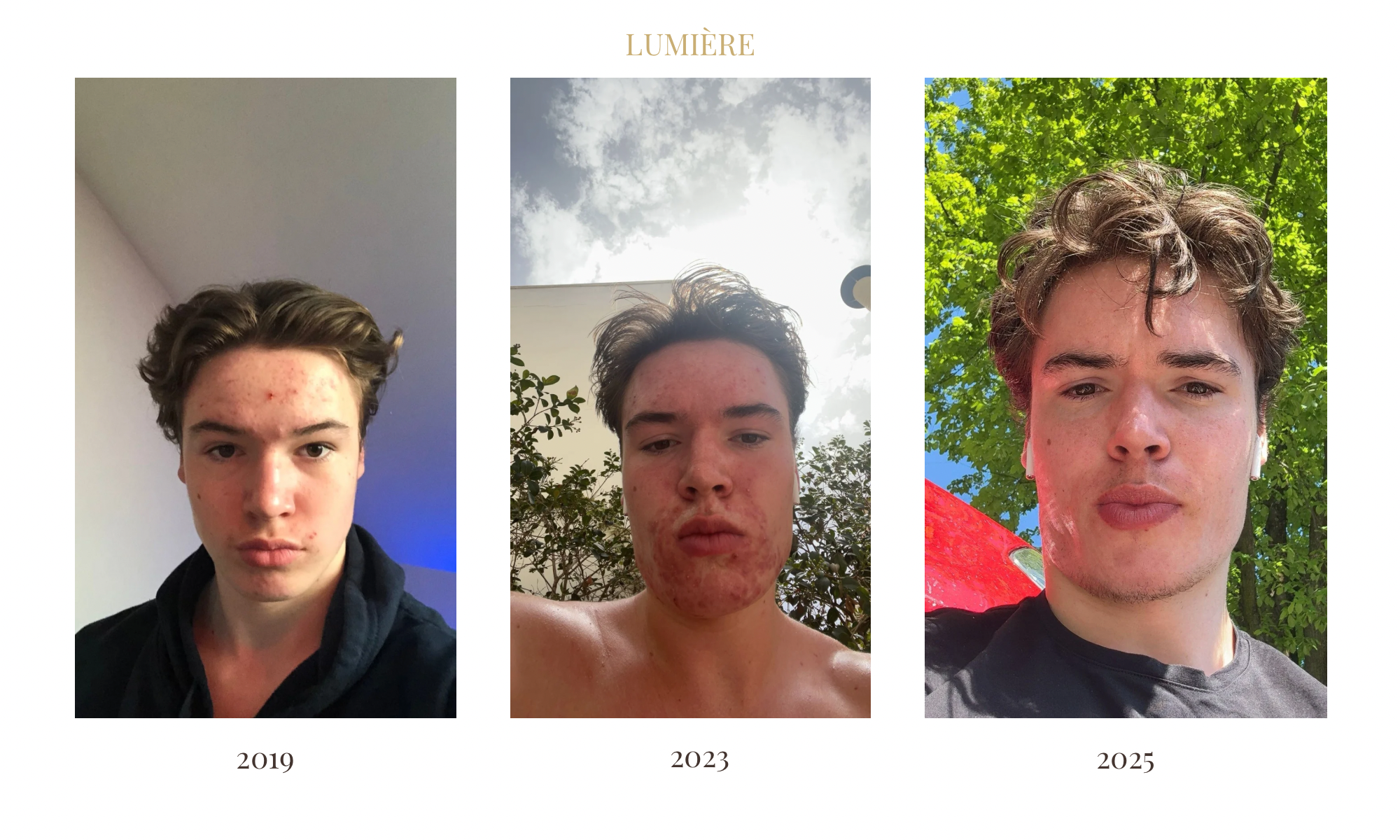 Before and after photo showing William's acne transformation journey — from persistent breakouts to clear, calm skin through gut health and lifestyle changes
