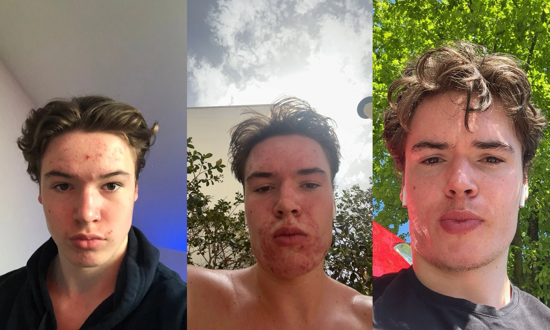 Before and after photo showing William's acne transformation journey — from persistent breakouts to clear, calm skin through gut health and lifestyle changes